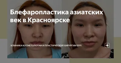 Что такое эстетическая офтальмология? Узнать цены и сделать себе красивые  глаза можно в Екатеринбурге в клинике Профессорская Плюс