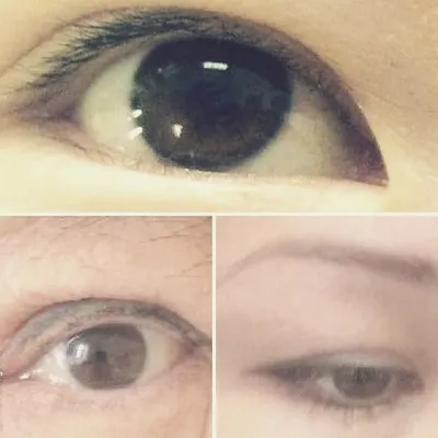 Нитевая Блефаропластика-без операционный метод ✓Подтяжка нависших век  ✓Создать складку для азиатских глаз ✓Исправить асимметрию… | Instagram