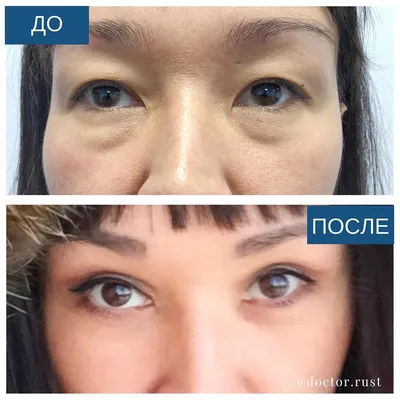 Блефаропластика азиатских глаз – «Dekamedical» Клиника. в Москве