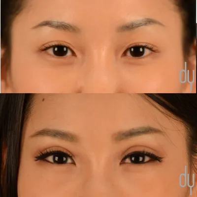 Блефаропластика азиатских глаз Major Beauty