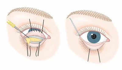 Блефаропластика верхних век. Бесшовная операция, верхняя блефаропластика  глаз, нависшего века. Цена в Москве в VIP Clinic. Стоимость узнать на сайте