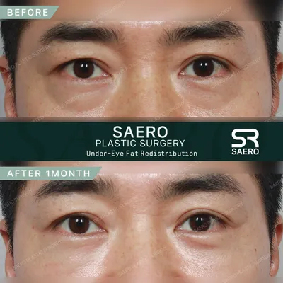 Blepharoplasty in Seoul | Clinics on Call