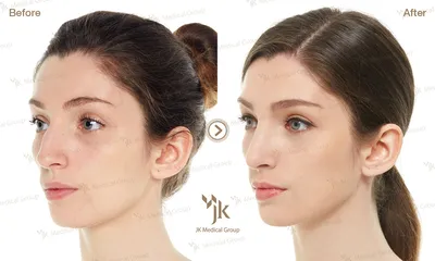 Клиника пластической хирургии YUNO, YUNO Plastic Surgery Russia - 💟  Блефаропластика 💟 Успейте сделать красивые глаза в период празднования  Чхусок 🌸 Запись и консультация: 010-3776-3500 #блефаропластика #сангапури  #доипосле #пластикасеул #Сеул #Корея ...