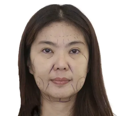 Лечение в Корее- Medictel Co. Ltd - Удивительный результат 1.Блефаропластика  (коррекция птоза без разреза)⠀ ⠀ 2. Операция на двойную челюсть ⠀ 3.  Операция по изменению контура лица (квадратная челюсть + гениопластика+  уменьшение