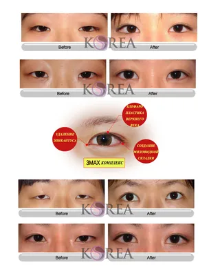 Пластические операции в Корее: блефаропластика