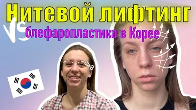 Пластическая хирургия | Блефаропластика в Корее | Medical Avenue