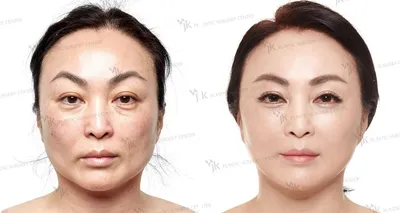 Blepharoplasty in Korea - Plastic Surgeon Choi Hong Lim [English Sub] -  YouTube