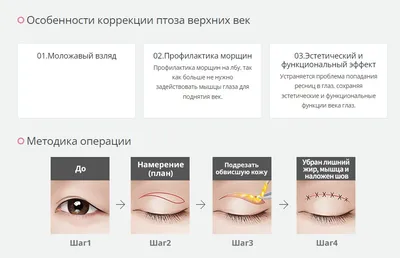 JW Korea - Красота и здоровье - Блефаропластика с коррекцией птоза и  эпикантопластика в Центре Пластической Хирургии JW! 😍 Подробнее про  блефаропластику узнайте тут https://bit.ly/3bUiMlz 👈 Красивый результат и  довольный пациент -