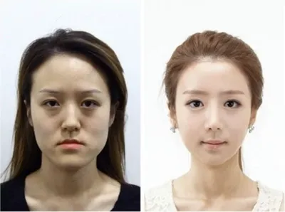 Самые популярные пластические операции в Корее | Заметки психолога | Дзен