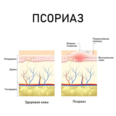 Порокератоз: дерматоскопические признаки