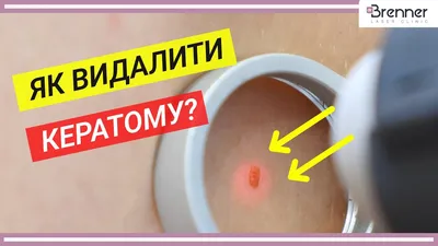 Себорейный дерматит - лечение у взрослых и детей в Санкт-Петербурге