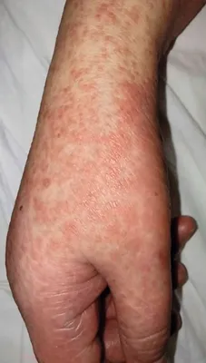 Pityriasis rubra pilaris (Devergie's disease) in a COVID-19 patient -  Okladnikova - Vestnik dermatologii i venerologii