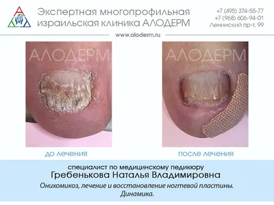 презентация болезнь Девержи | Шпаргалки Дерматология | Docsity