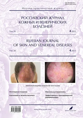 PDF) Programmed use of extracorporeal photochemotherapy in the complex  treatment of Devergey's disease