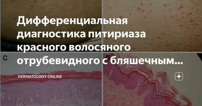 Мазь для наружного применения «Ретиноиды» Уродерм - «Неравный бой с  фолликулярным гиперкератозом - часть 3, мазь Уродерм» | отзывы