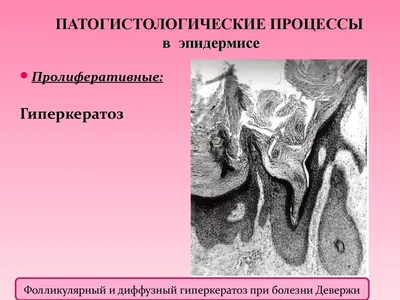 Себорейный дерматит у больных с психоневрологическими расстройствам