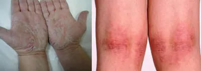 экзема кожа болезни на ногах зуд красные высыпания и пятна Стоковое Фото -  изображение насчитывающей перчатка, экзема: 220713888