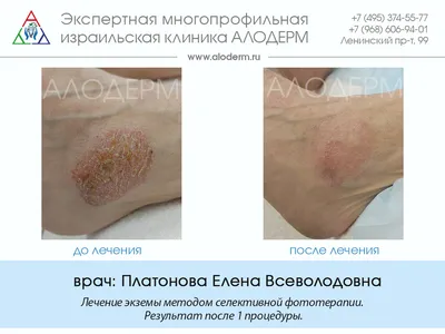 Аллергическая сыпь дерматит экзема кожи на ноге пациента. Псориаз и экзема  кожи с большими красными пятнами. Концепция здоровья стоковое фото  ©ternavskaia.o@gmail.com 200428718