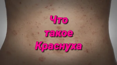 Краснуха у ребенка: полное описание, симптомы и причины