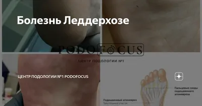 Центр Стопи Beonfeet - Полезно знать👣 ⠀ 💠Болезнь Леддерхозе —  заболевание, обусловленное развитием рубцового сморщивания подошвенного  апоневроза. Впервые описана немецким хирургом G. Ledderhose (1855–1925). ⠀  💠В результате постепенного сокращения ...