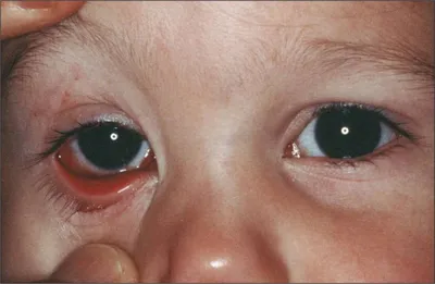 Болезни глаз у детей фото фото