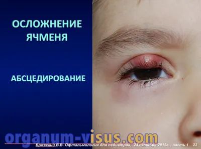 Болезни век, Diseases of Eyelids | Орган Зрения