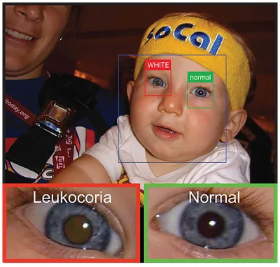 Глаукома: каждый должен знать - причины, симптомы, лечение и профилактика
