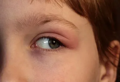 Что делать, если у ребёнка аллергия? — Медицинский центр «Целитель»