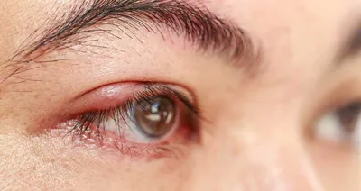 Амблиопия «ленивый глаз» - степени и лечение у взрослых и детей