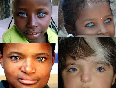 Птеригиум глаза – симптомы, причины, диагностика и способы лечения  заболевания в клинике «Будь Здоров»