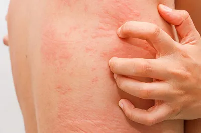 Бактериальные инфекции кожи: какие бывают, как лечить. Правила профилактики