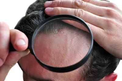 Лечение себореи волосистой части головы – Публикации – Лаборатория Ан-Тек