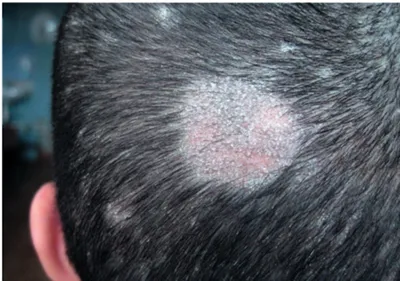 Воспаление кожи головы - диагностика и лечение в 100med