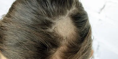 Псориаз волосистой части головы. Симптомы | МЦ Данимед