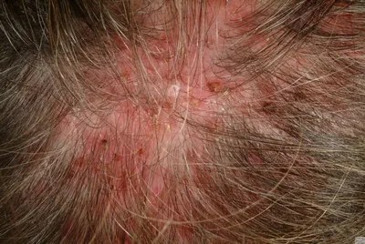 Зуд кожи головы — 7 возможных причин — что делать при зуде кожи головы и  выпадении волос