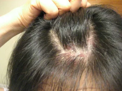 Пиодермия кожи головы: причины появления гнойников, лечение