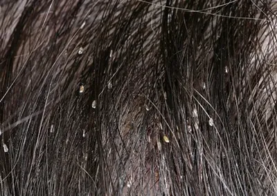 Псориаз волосистой части головы - лечение псориаза, консультация и цены в  Одессе и Украине