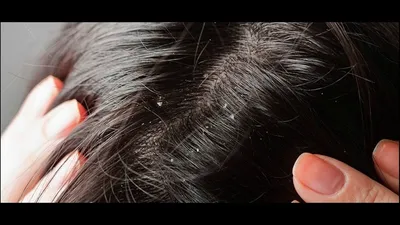 Заболевания волос и кожи головы. | Всё о стрижках и волосах | Дзен