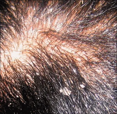 Как работает мезотерапия для волос — блог медицинского центра ОН Клиник