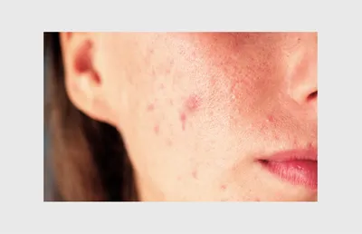 5 правил ухода за кожей при атопическом дерматите