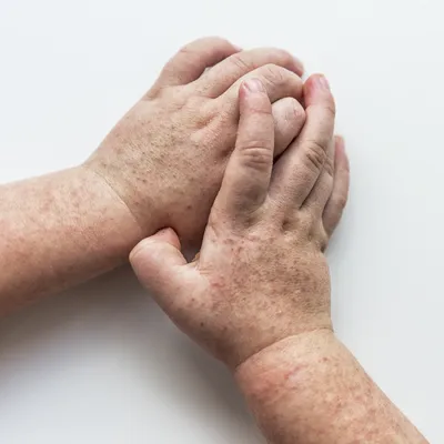 Лечение сухой кожи рук: что делать, причины, как лечить и избавиться от  сухости