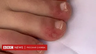 Красные руки назвали симптомом смертельно опасной болезни – Москва 24,  24.01.2021