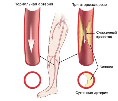 Лечебный педикюр при грибке ногтей в СПб | клиника «Ева»