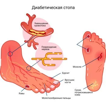 Педикюр при проблемных стопах: что надо знать мастеру ногтевого сервиса