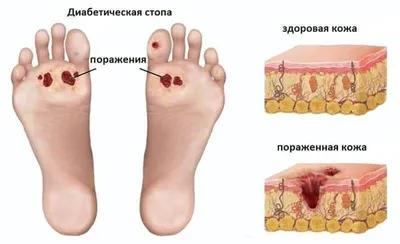 Микоз стоп: как проявляется, как лечить?