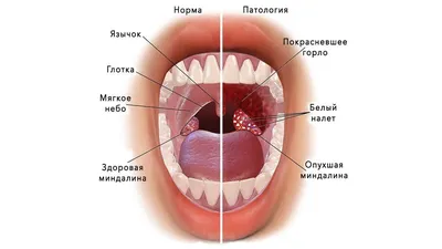 Почему появляются белые пятна во рту? 6 возможных причин | Стоматология  ROOTT | Дзен