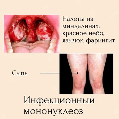 Изменения на слизистой полости рта могут указывать на болезни  желудочно-кишечного тракта, легких и сердца