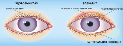 Синдром сухого глаза - симптомы, причины, диагностика и лечение