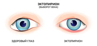 Киста глаза - признаки, причины, симптомы, лечение и профилактика -  iDoctor.kz