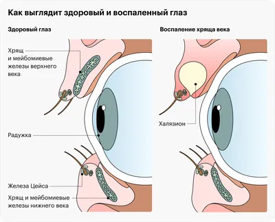 Ячмень на глазу у взрослых и детей: лечение, причины, стадии, признаки и  симптомы